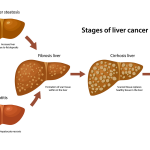 Bile Imbalance Linked to Liver Cancer: New Insights